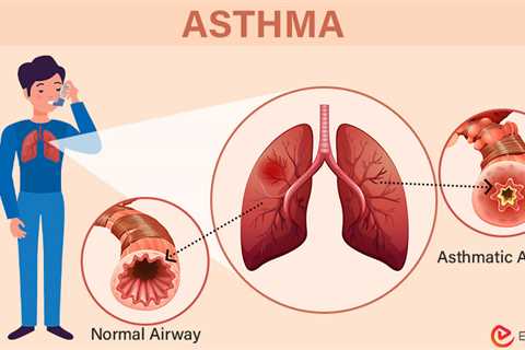 What is Asthma